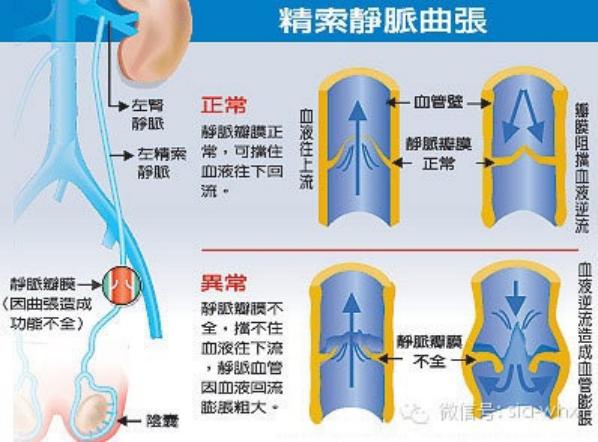 關(guān)于2021年征兵精索靜脈曲張標(biāo)準(zhǔn)的探討，2021年征兵精索靜脈曲張標(biāo)準(zhǔn)深度解析
