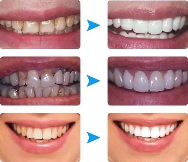 牙齒洗白要多少錢(qián)？全面解析牙齒美白費(fèi)用因素，牙齒美白費(fèi)用全解析，牙齒洗白需要多少錢(qián)？