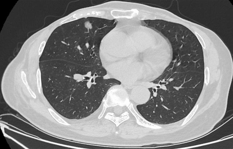 肺結(jié)節(jié)最佳治療方法，全面解析與你的健康之路，肺結(jié)節(jié)最佳治療方法詳解，為您的健康之路指引方向