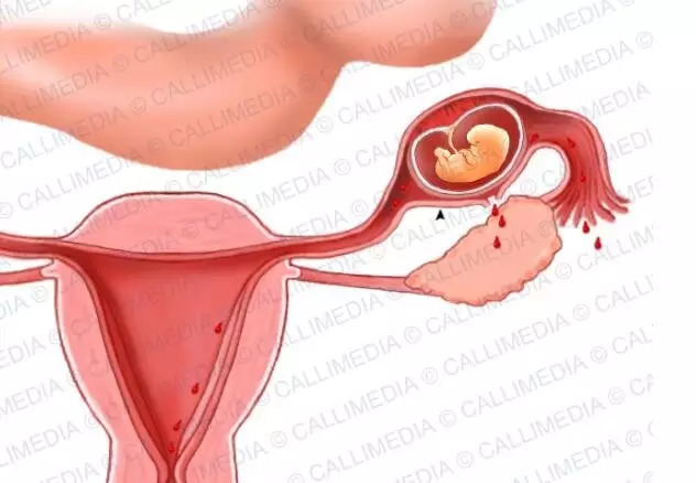 宮外孕20天最明顯的征兆，宮外孕20天的明顯征兆，早期識別與應(yīng)對的關(guān)鍵時(shí)刻