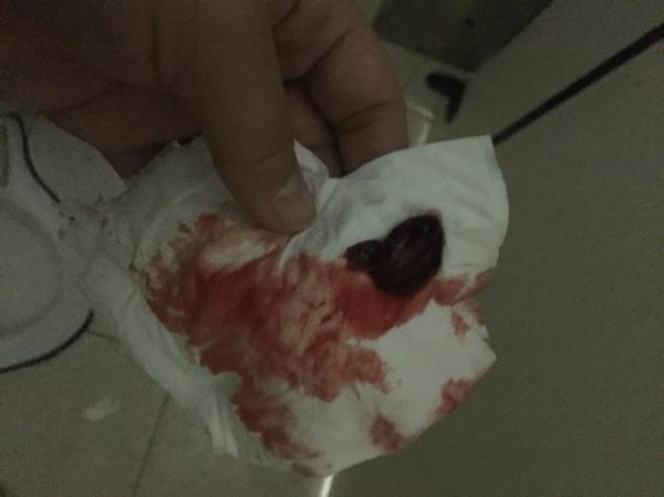 自然流產(chǎn)后的清宮問題解析——自己流掉了需要清宮嗎？，自然流產(chǎn)后需清宮嗎？——深度解析清宮問題疑慮！