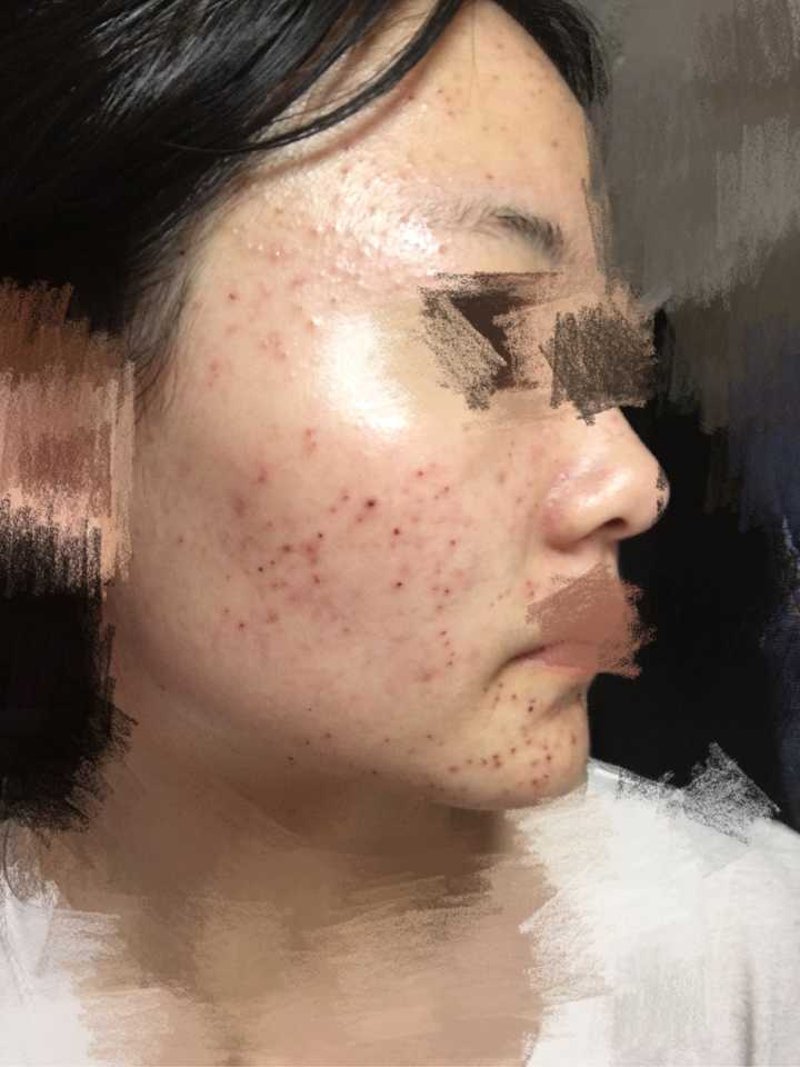 激光祛痘痘有效果嗎，深度解析與全面理解，激光祛痘效果深度解析與全面理解指南