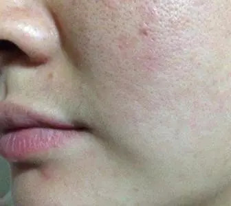 臉上毛孔粗大怎么辦？全方位解決方案助你擁有細(xì)膩肌膚，全方位解決毛孔粗大難題，讓你擁有細(xì)膩肌膚的秘訣！