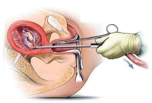流產(chǎn)最小的傷害是哪一種，探討不同流產(chǎn)方式的利弊與選擇策略，探討不同流產(chǎn)方式的利弊，尋找最小傷害的選擇策略