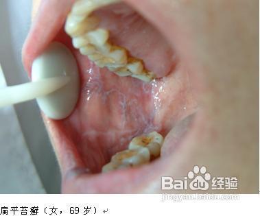 口腔扁平苔蘚，了解、預防與治療，口腔扁平苔蘚，了解、預防與治療全攻略