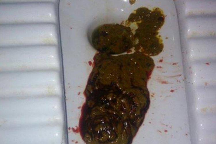 拉屎拉出鮮紅的血不痛，原因分析及應對措施，無痛性鮮紅便血原因解析與應對方案