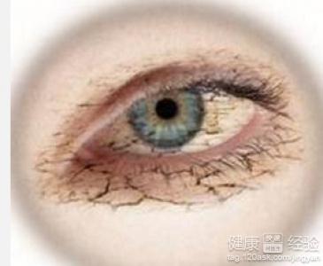 干眼癥怎樣能徹底治愈，全面理解與有效治療策略，全面理解與有效治療策略，干眼癥的根治之路