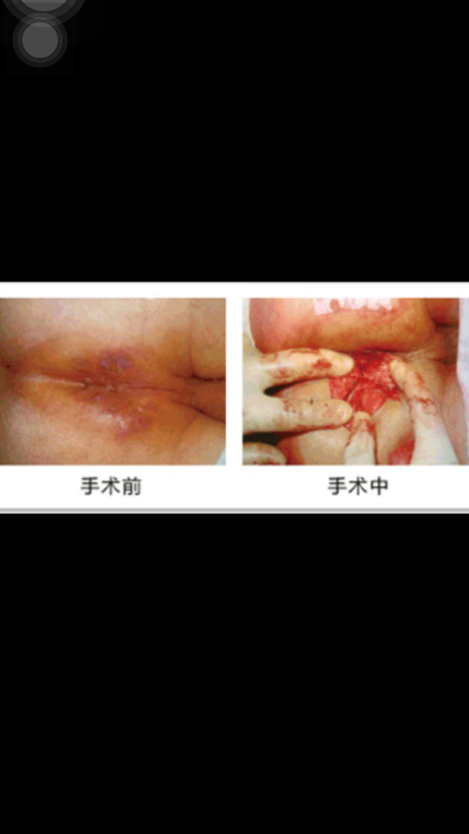 肛瘺圖片，了解癥狀、診斷與治療，肛瘺詳解，癥狀、診斷、治療及圖片參考